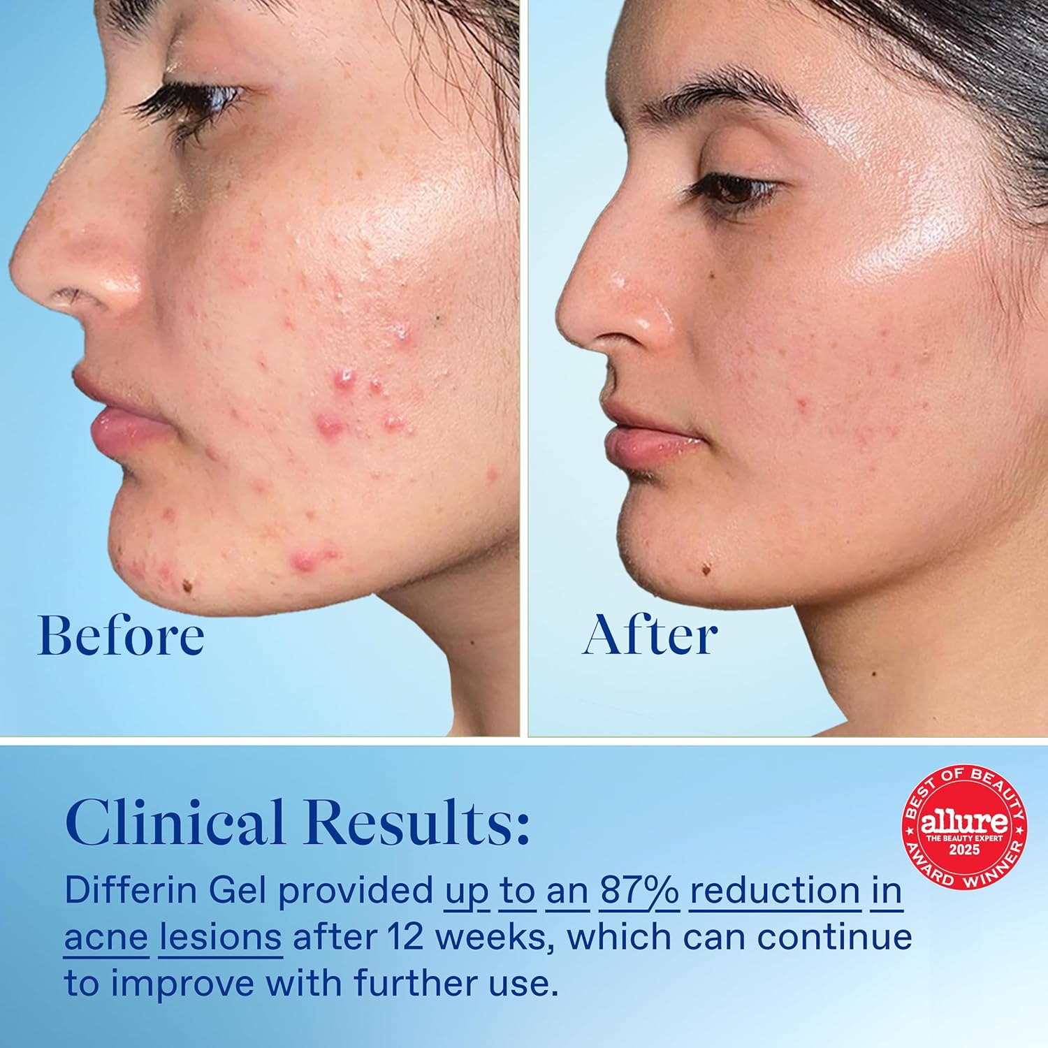 Acne Treatment Gel. 60 Day Supply. Retinoid Treatment for Face with 0.1% Adapalene. Gentle Skin Care for Acne Prone Sensitive Skin.