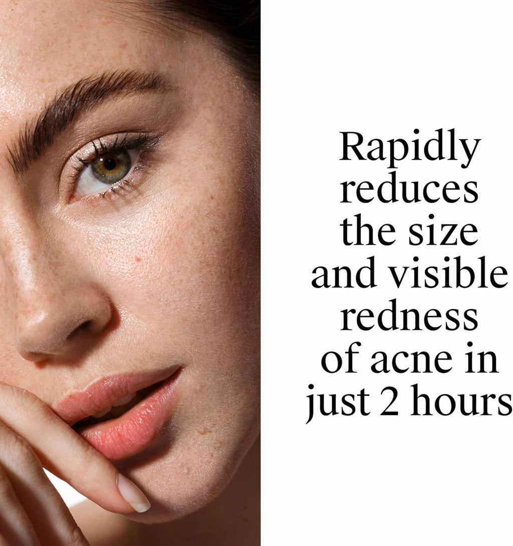 Neutrogena Rapid Clear Stubborn Acne Spot Treatment Gel. Maximum Strength 10% Benzoyl Peroxide Treatment Medication for Acne Prone Skin. Pimple Cream Reduces Size & Redness. 1 oz : Beauty & Personal Care
