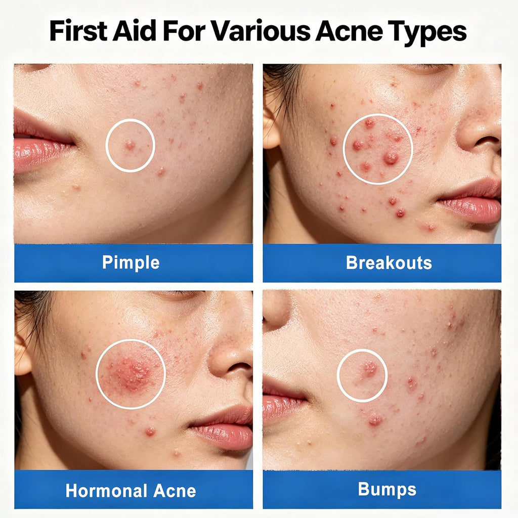 Salicylic Acid Acne Serum. Acne Drying Lotion for Acne-Prone Sensitive Skin. Shrinks Pimples Overnight. Fade Acne Marks. 20% Zinc Oxide Medicated Spot Treatment for Pimples and Blemishes. 0.34 fl oz : Beauty & Personal Care