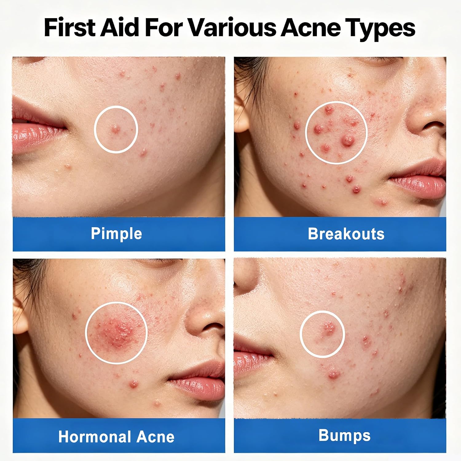 Salicylic Acid Acne Serum. Acne Drying Lotion for Acne-Prone Sensitive Skin. Shrinks Pimples Overnight. Fade Acne Marks. 20% Zinc Oxide Medicated Spot Treatment for Pimples and Blemishes. 0.34 fl oz : Beauty & Personal Care