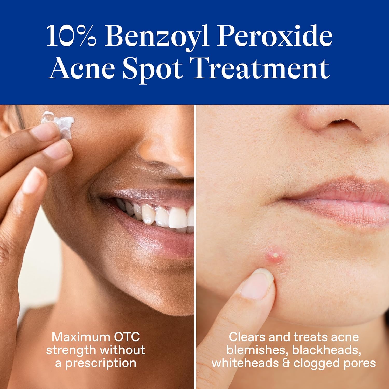 Differin Acne Spot Treatment with 10% Benzoyl Peroxide. Maximum Strength OTC Acne Treatment. Fast Acting Spot Treatment for Face. 1 oz : Beauty & Personal Care