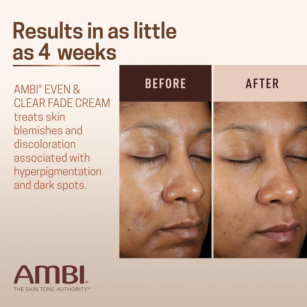 Ambi Even & Clear Fade Cream. Hydroquinone-free. Hyperpigmentation Treatment. Dark Spot Corrector. Results In As Little As 4 Weeks. Niacinamide. Aloe Vera. Vitamin C. 1 Fl Oz : Beauty & Personal Care