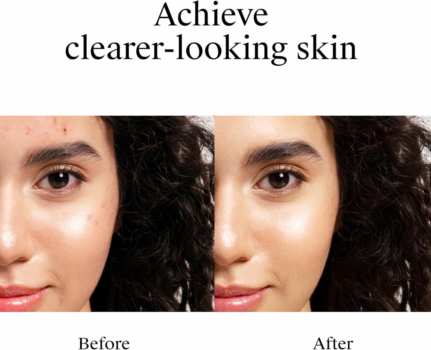 Neutrogena Rapid Clear Stubborn Acne Spot Treatment Gel. Maximum Strength 10% Benzoyl Peroxide Treatment Medication for Acne Prone Skin. Pimple Cream Reduces Size & Redness. 1 oz : Beauty & Personal Care