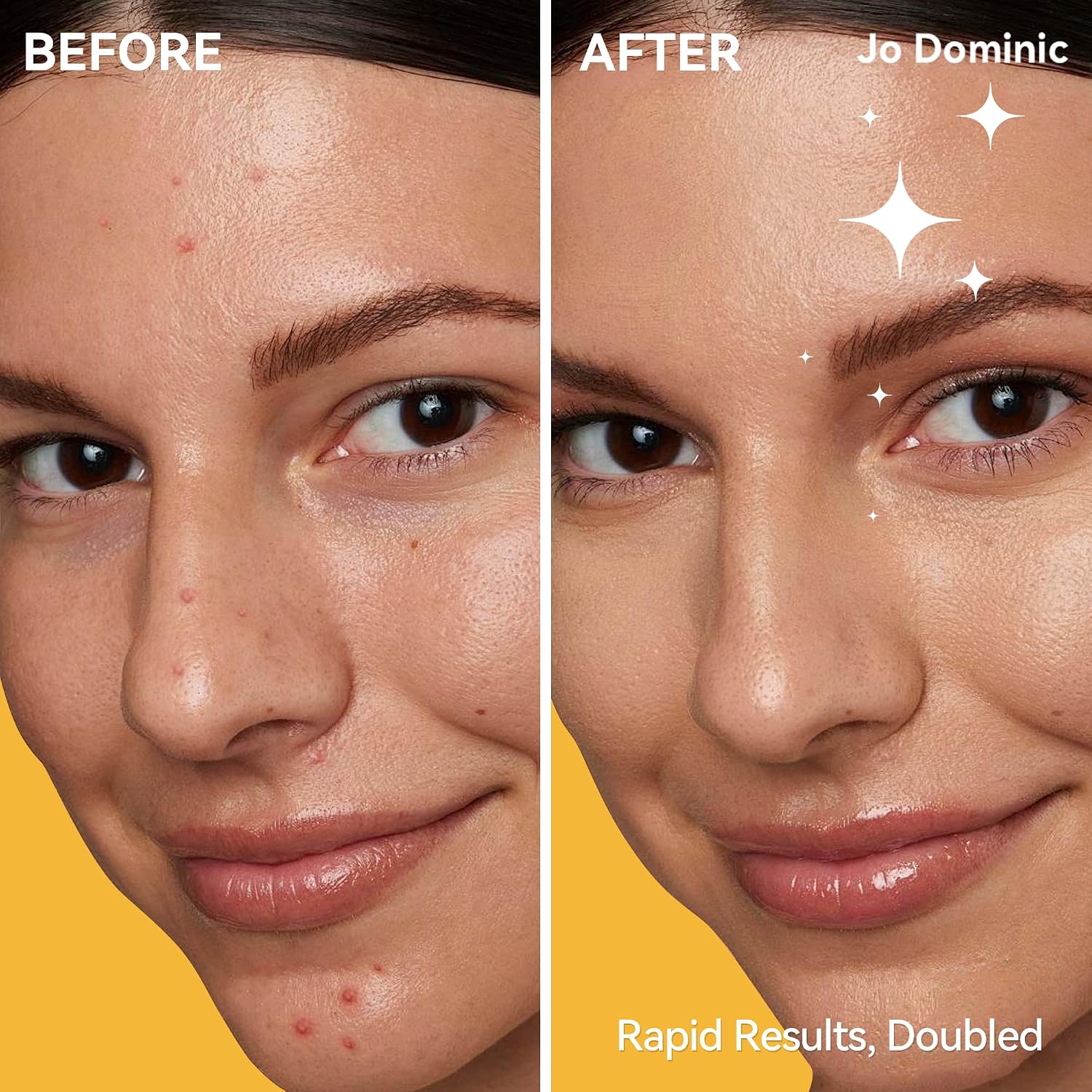 Jo Dominic MAGIX PATCH T-Zone Acne Patches Large Hydrocolloid Pimple Patches for Forehead. Nose & Chin – Absorbs Oil & Blemishes Fast – Vegan & Cruelty-Free (12 Count) : Beauty & Personal Care