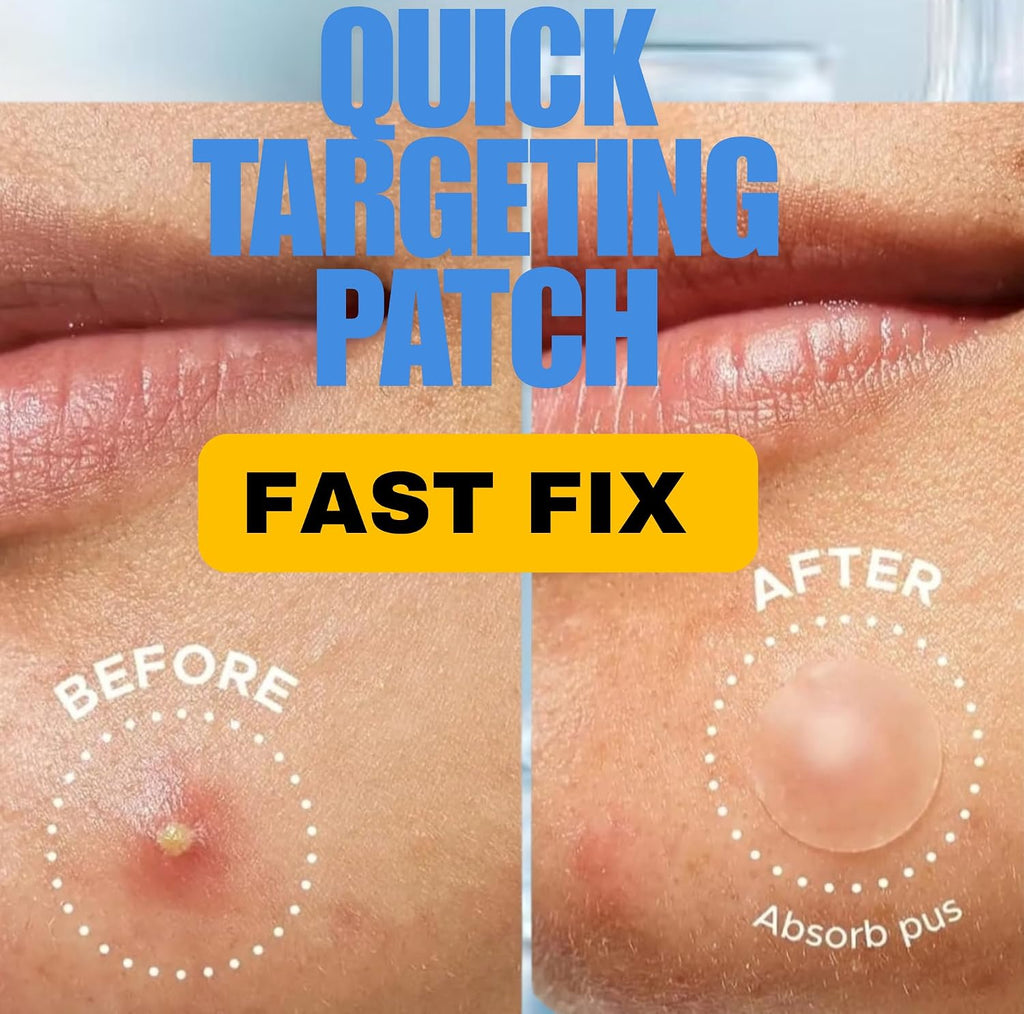 SEEDRAFOX Super Pimple Patch for Acne & Pimples | Hydrocolloid Acne Patch with Salicylic Acid & Niacinamide | Invisible Pimple Spot Patch | Ultra Thin Invisible Patches for Face | 108 Patches : Beauty & Personal Care