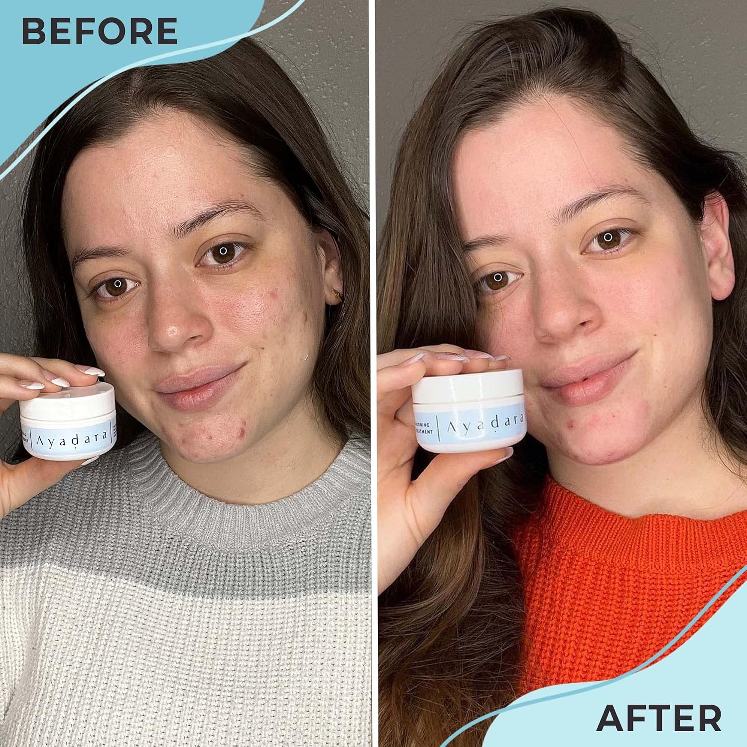 Ayadara Warrior One (0.5oz) Acne Spot Cream with 2% Salicylic Acid. Cystic and Hormonal Acne Cream. Acido Salicilico Acne Spot Care for Face. acne Cream for Adults and Teens. 150+ Uses