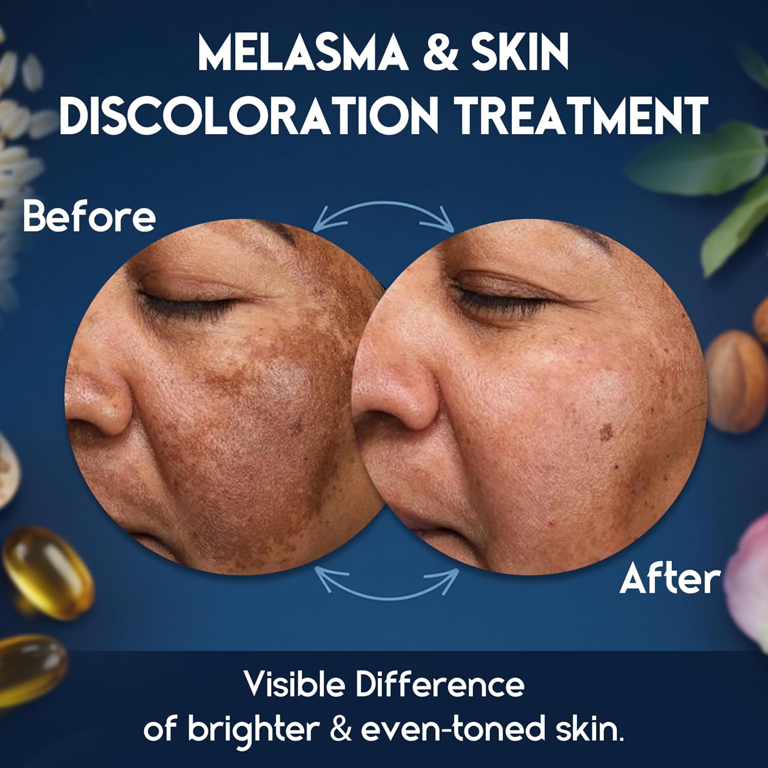 Treatment for Face - Melasma Cream & Age Spot Remover for Skin Discoloration. Post-Blemish Marks. Scars & Spots | Dark Spot Remover for Face & Body : Beauty & Personal Care