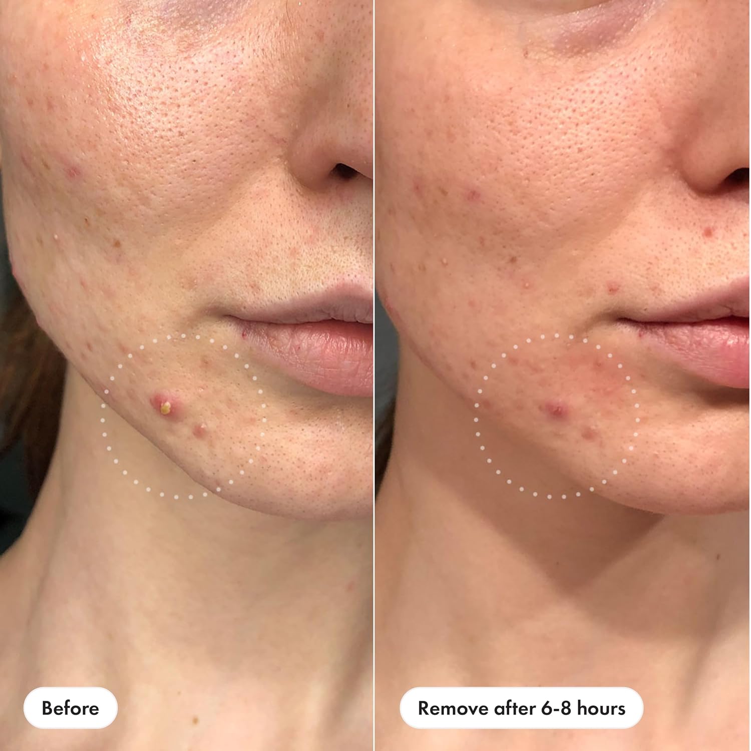Mighty Patch™ Invisible+ Patch – The Barely-There Daytime Hydrocolloid Acne Pimple Patch for Covering Zits and Blemishes. Tapered Edges Designed to Blend Into Skin (72ct)