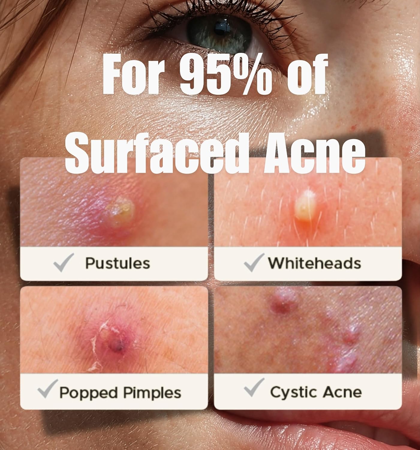 Super Pimple Patch for Acne & Pimples | Hydrocolloid Acne Patch with Salicylic Acid & Niacinamide | Invisible Pimple Spot Patch | Ultra Thin Invisible Patches for Face | 216 Patches