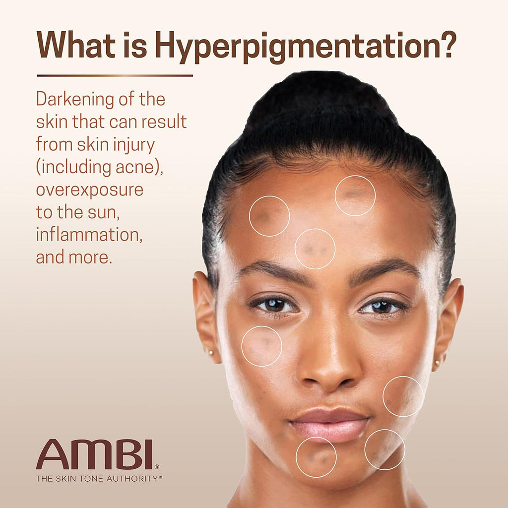 Ambi Even & Clear Fade Cream. Hydroquinone-free. Hyperpigmentation Treatment. Dark Spot Corrector. Results In As Little As 4 Weeks. Niacinamide. Aloe Vera. Vitamin C. 1 Fl Oz : Beauty & Personal Care