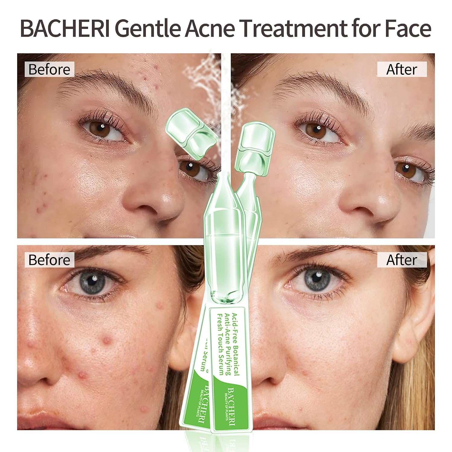 Gentle Botanical Acne Treatment for Face – Acid-Free Spot Facial Serum with Niacinamide & Witch Hazel. Soothes Redness & Controls Breakouts for Sensitive. Oily & Acne-Prone Skin – 1.2 ml × 30 Ampoules