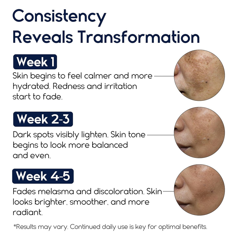 Treatment for Face - Melasma Cream & Age Spot Remover for Skin Discoloration. Post-Blemish Marks. Scars & Spots | Dark Spot Remover for Face & Body : Beauty & Personal Care