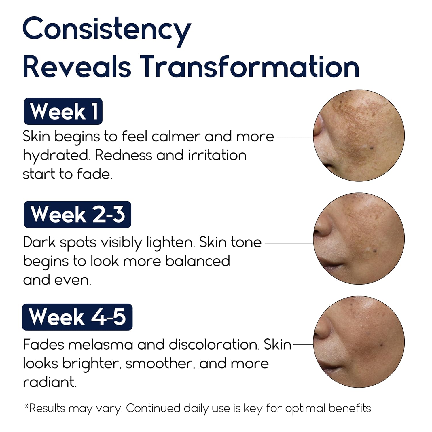 Treatment for Face - Melasma Cream & Age Spot Remover for Skin Discoloration. Post-Blemish Marks. Scars & Spots | Dark Spot Remover for Face & Body : Beauty & Personal Care