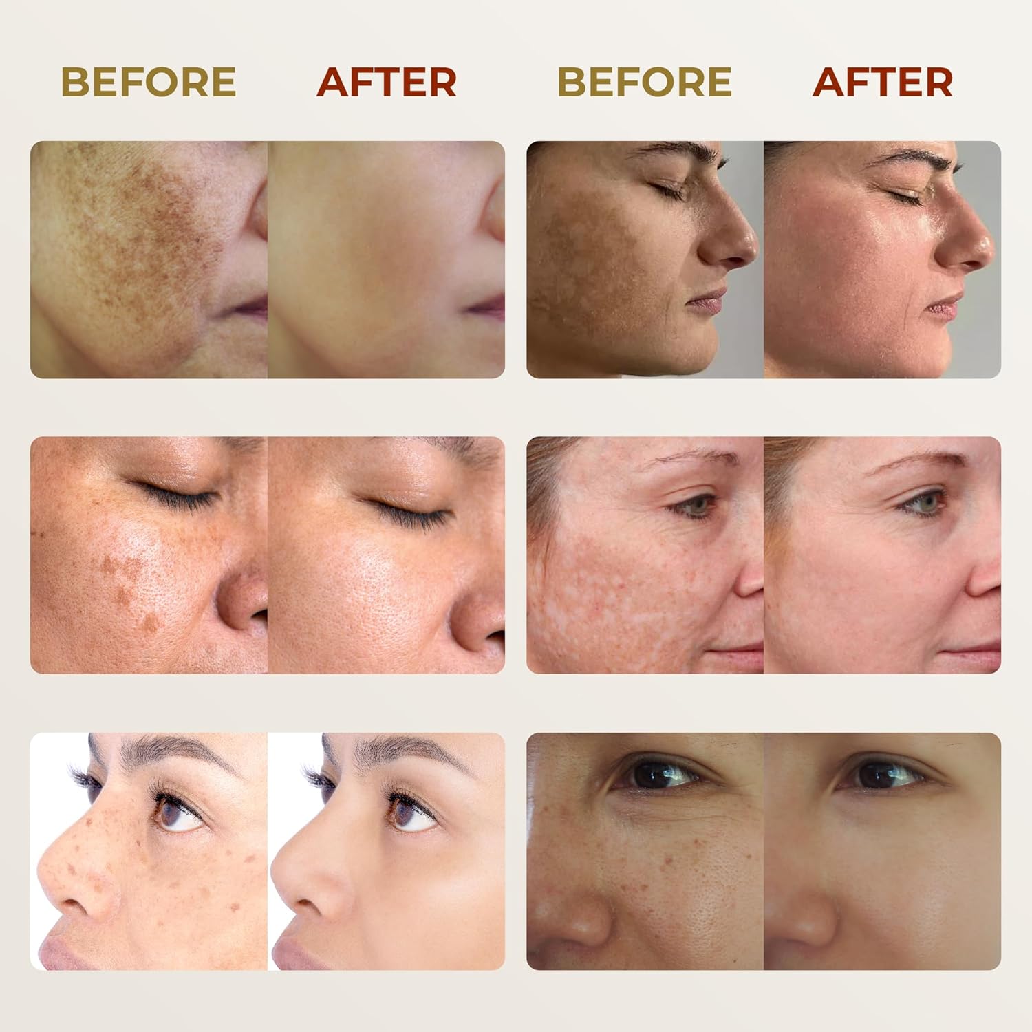 Melasma Cream (Premium Version) - Dark Spot Corrector. Melasma. Freckle. Sun Spot. Age Spot Remover Advanced Formula for Women and Men (0.7 Oz Per Item) : Beauty & Personal Care